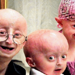 Progeria de Hutchinson-Gilford